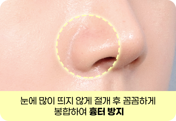 디에이 콧볼축소