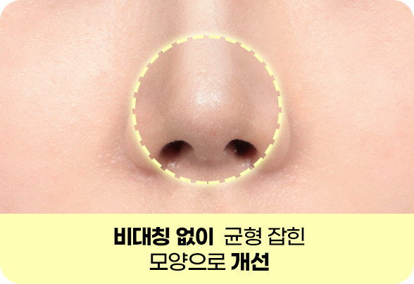 디에이 콧볼축소