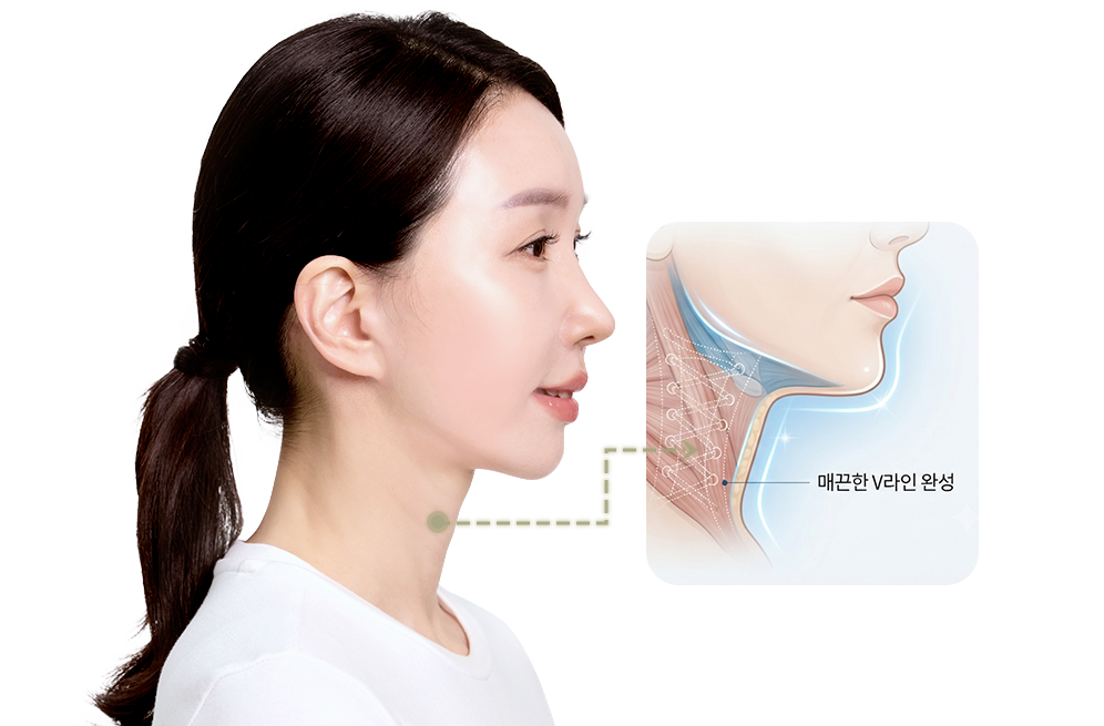 디에이 연조직 이중턱 근육묶기