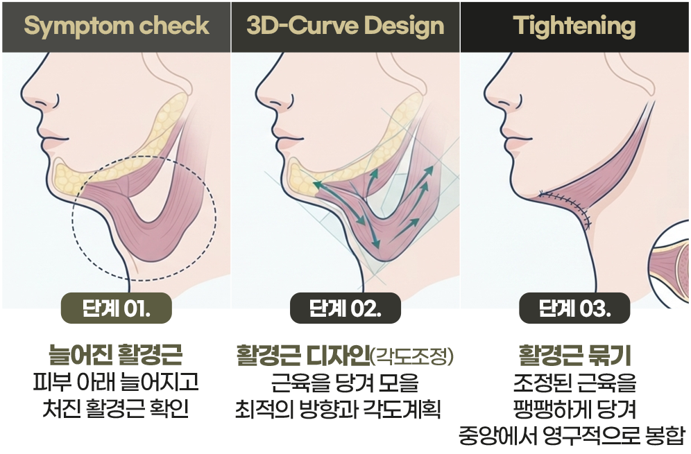 연조직 이중턱 근육묶기