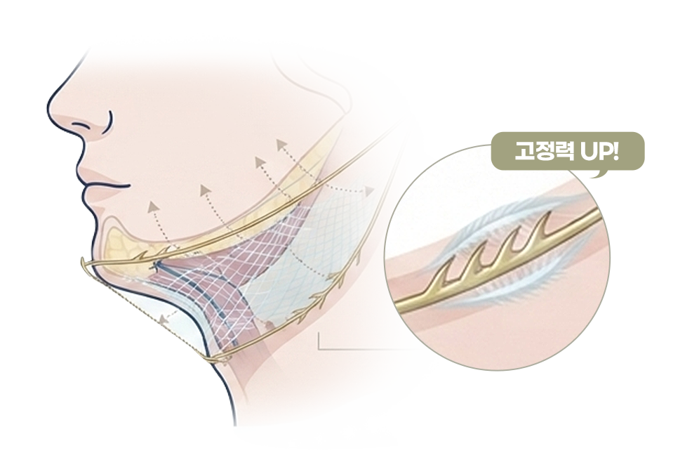 연조직 이중턱 근육묶기