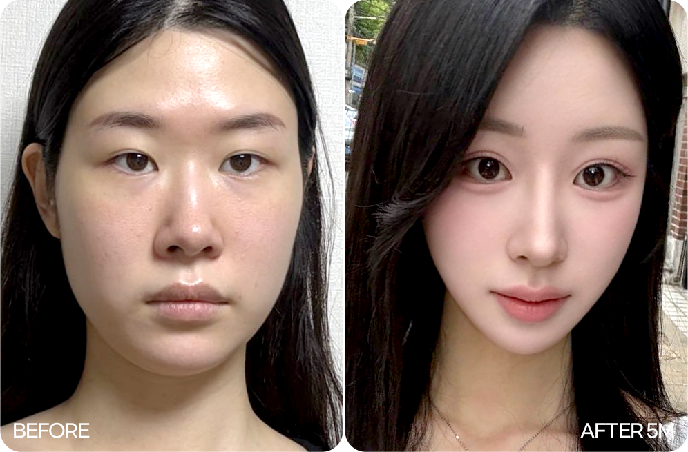 연조직 이중턱 근육묶기