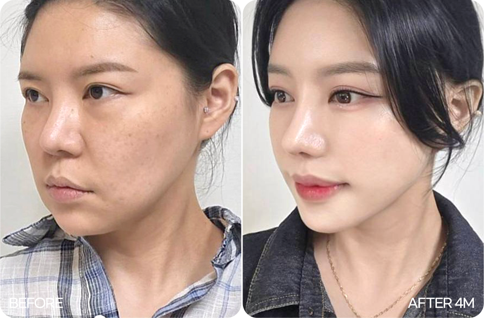 연조직 이중턱 근육묶기