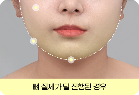디에이 안면윤곽 재수술
