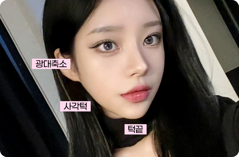 디에이 코 재수술