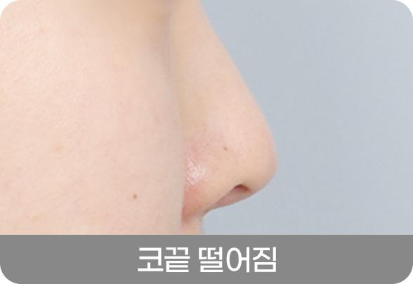 디에이 코 재수술