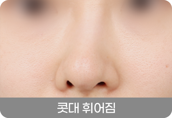 디에이 코 재수술