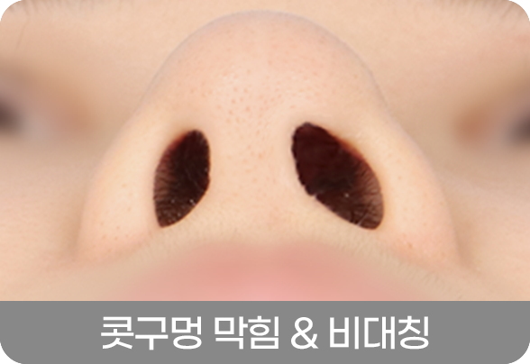 디에이 코 재수술