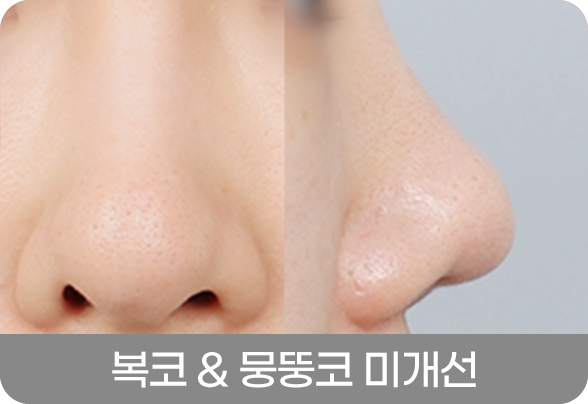 디에이 코 재수술
