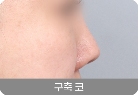 디에이 코 재수술