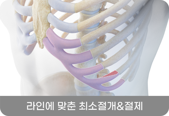 디에이 코 재수술