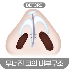 디에이 코 재수술