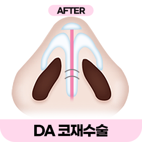 디에이 코 재수술