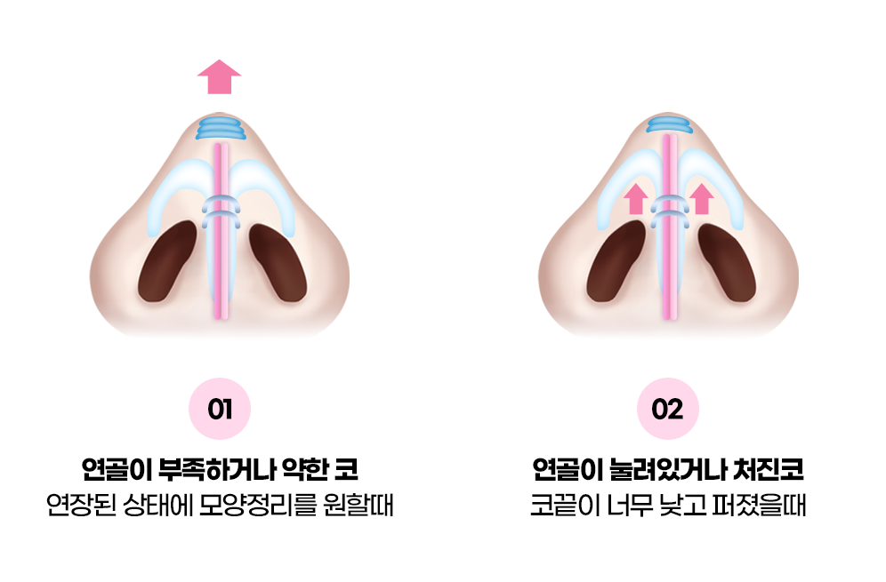 디에이 코 재수술
