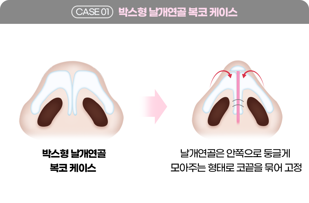 디에이 코 재수술