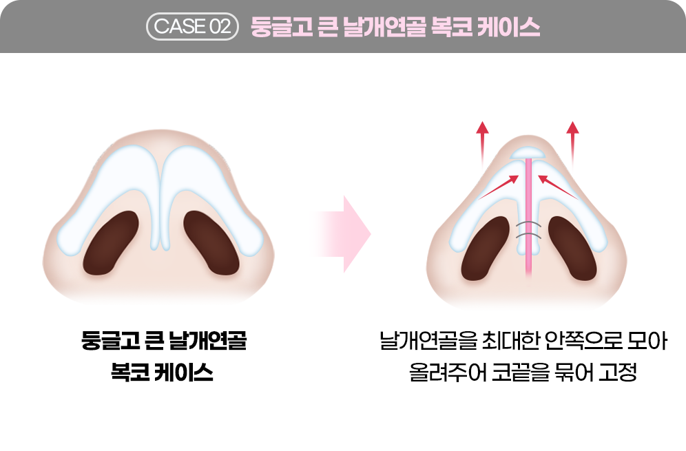 디에이 코 재수술