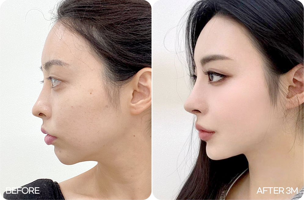 디에이 코 재수술