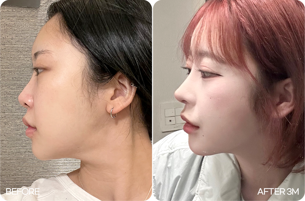 디에이 코 재수술