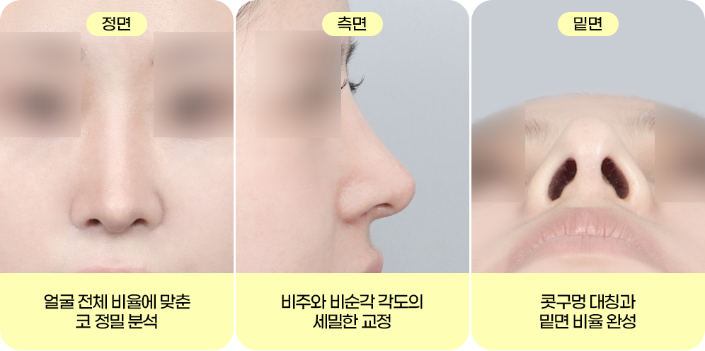 디에이 자려한코성형 비주 길이 컨트롤 CASE