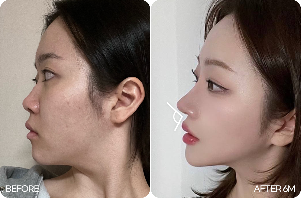 디에이 자려한코성형 비순각과 인중의 예쁜 비율