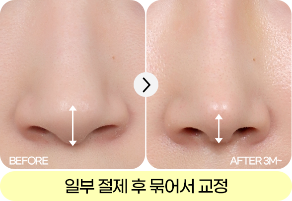 디에이 자려한코성형 비주 길이 컨트롤 CASE
