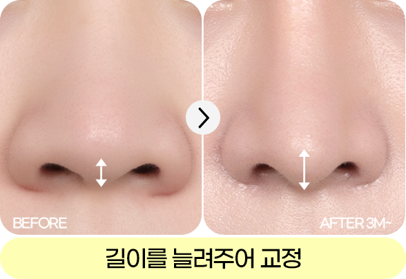 디에이 자려한코성형 비주 길이 컨트롤 CASE