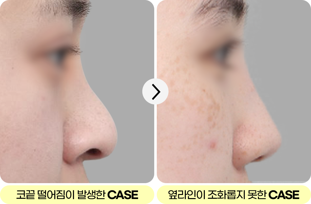 디에이 자려한코성형 CASE