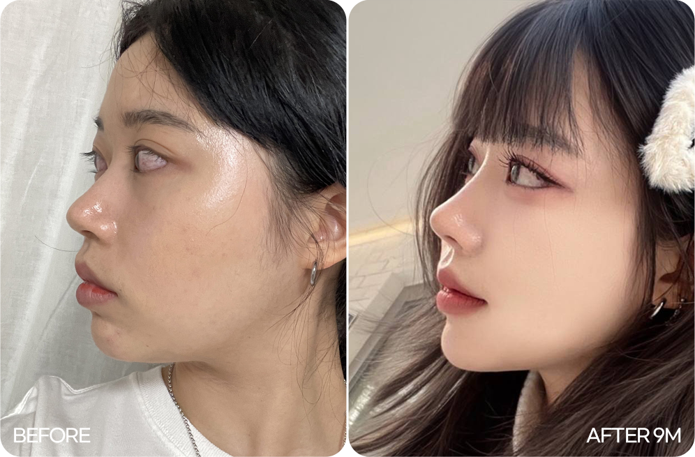 디에이 자려한코성형 화려한 예쁜코 유지력 01