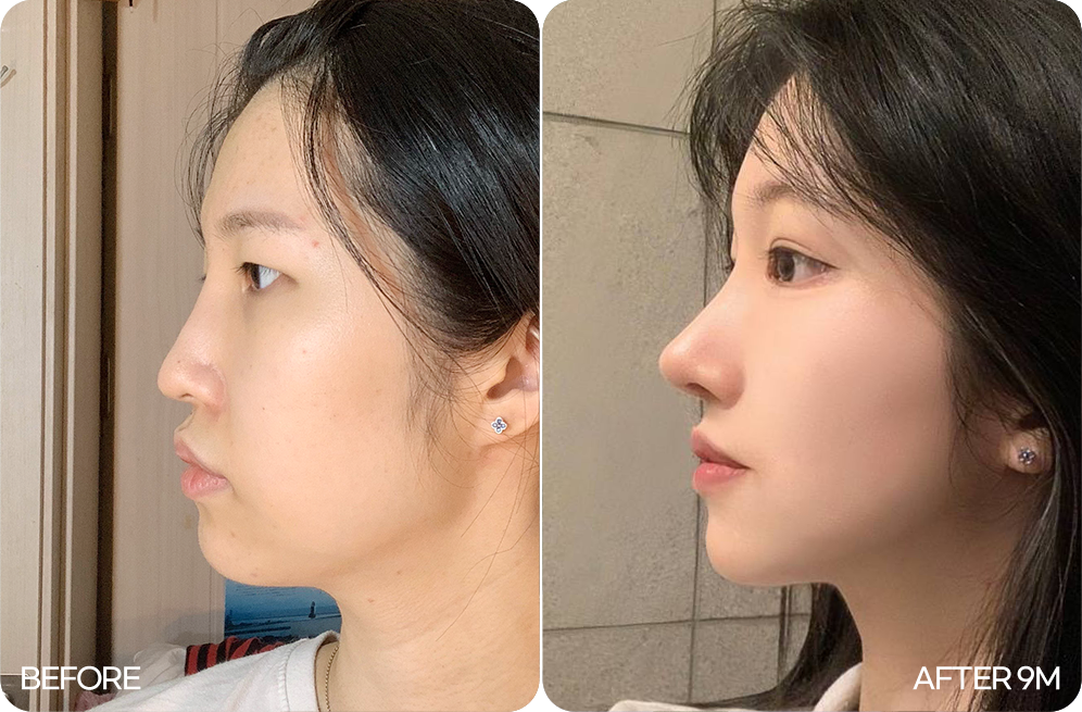 디에이 자려한코성형 화려한 예쁜코 유지력 04
