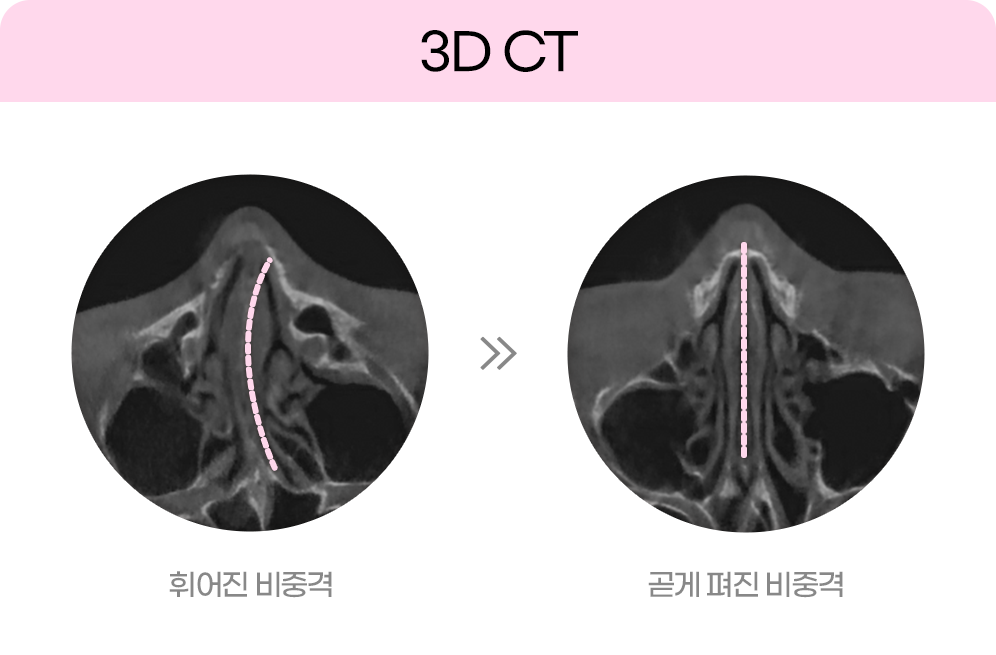 디에이 비염미용코성형