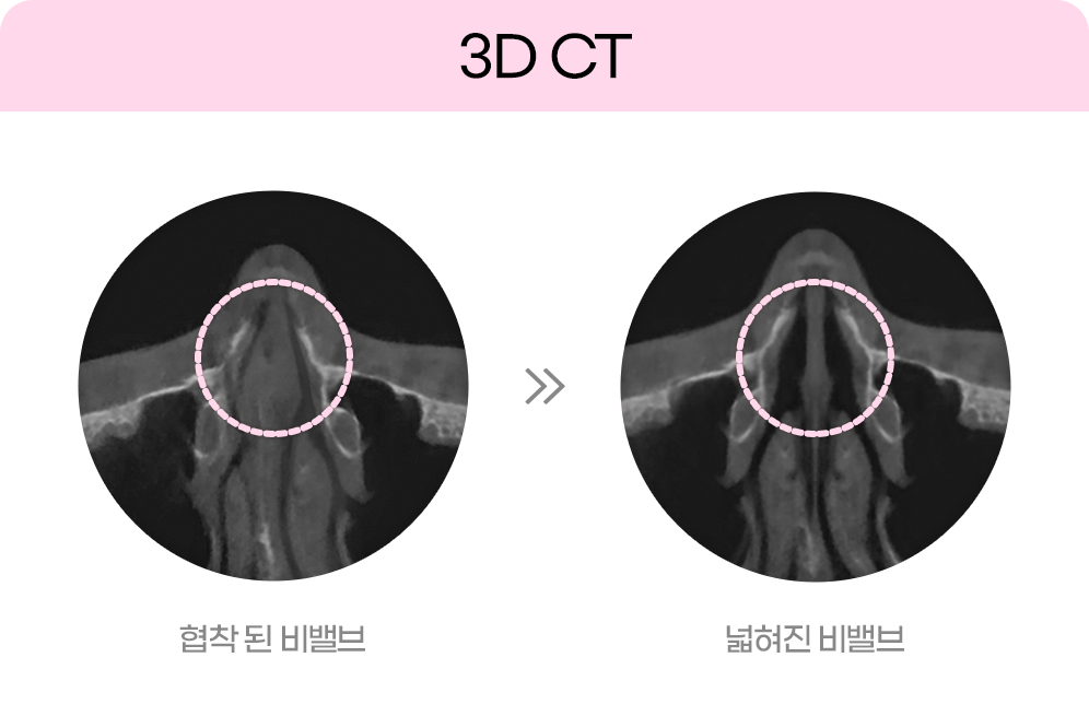 디에이 비염미용코성형