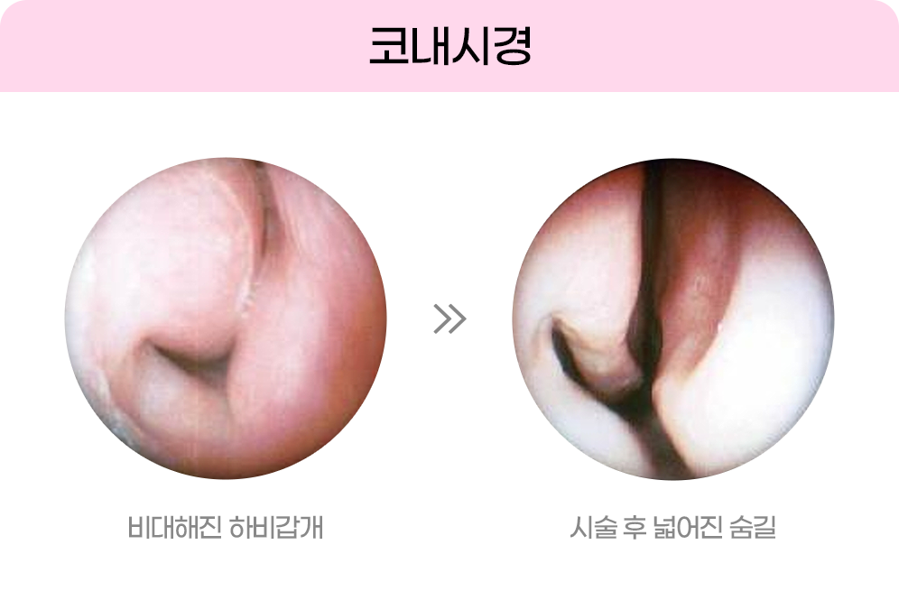 디에이 비염미용코성형