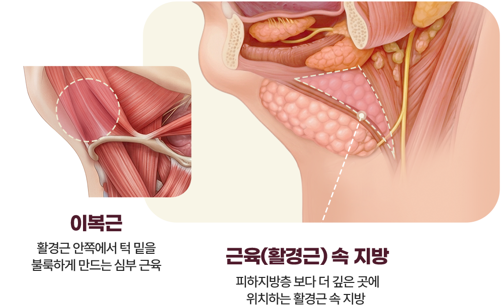 이중턱 삭제술