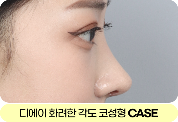 디에이 각도 코성형