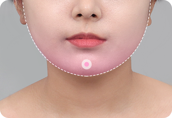 디에이 안면윤곽 재수술