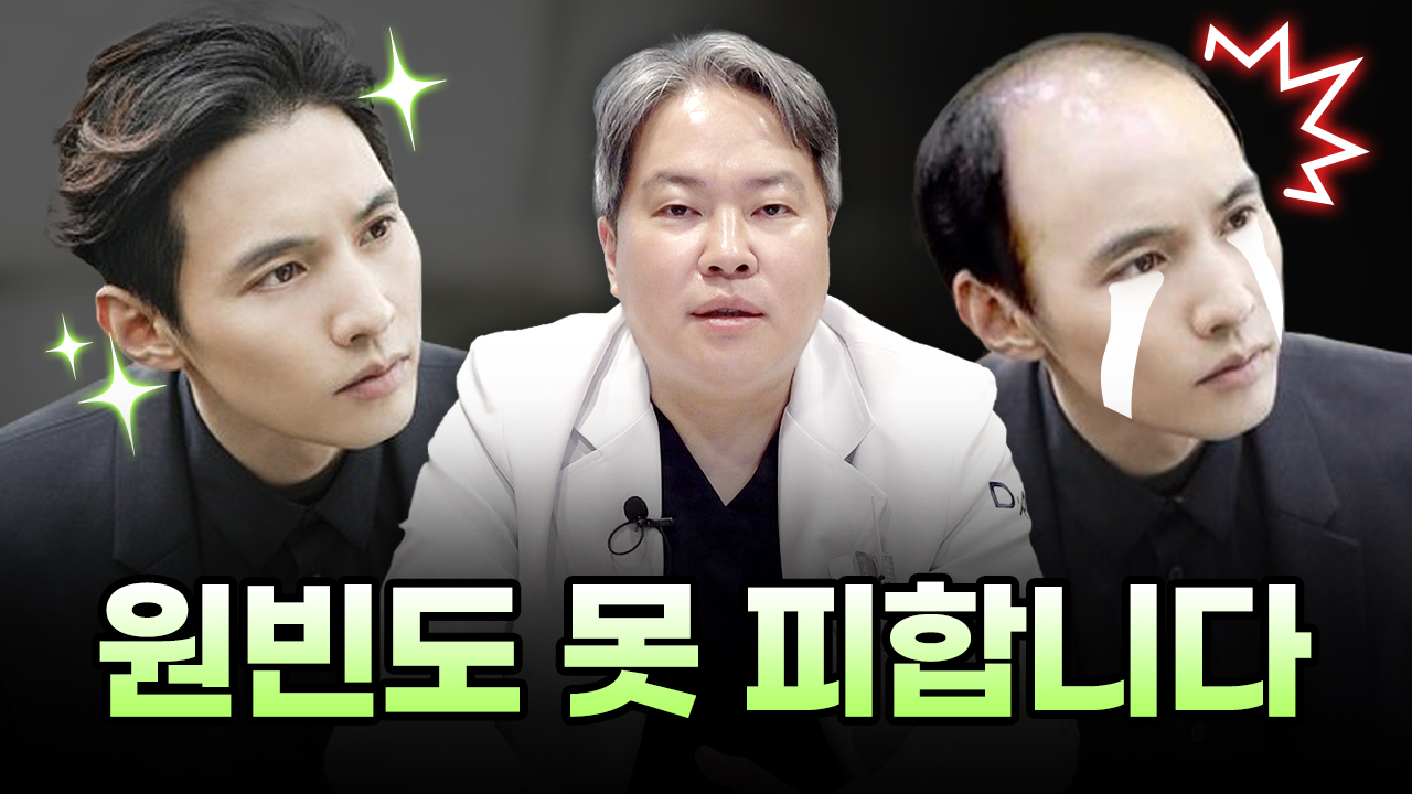 탈모오면 원빈도 못생김 못 피합니다